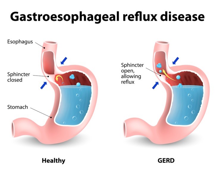 GERD,  gastro-oesophageal reflux disease, medical, GetDoc